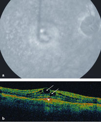 Macular Degeneration