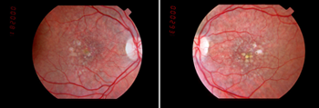 Macular Degeneration
