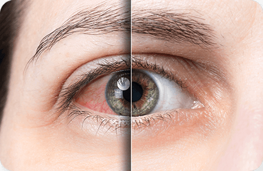 What is dry eye?